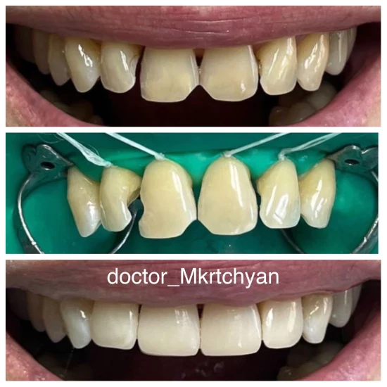 Художественная реставрация зубов